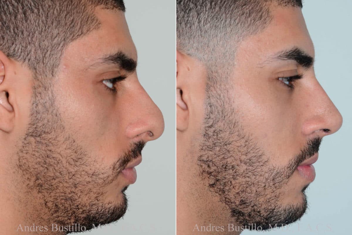 Before and after rhinoplasty surgery changes.