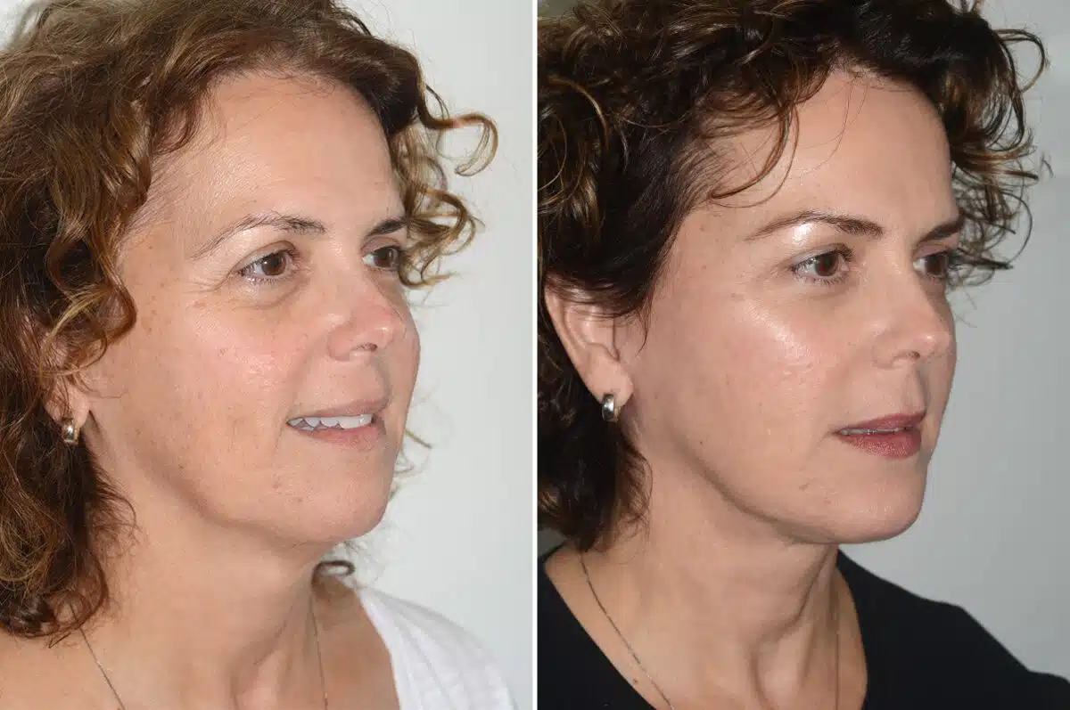 Brow Lift Before and After Photos in Miami, FL, Patient 22862