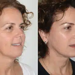 Brow Lift Before and After Photos in Miami, FL, Patient 22862