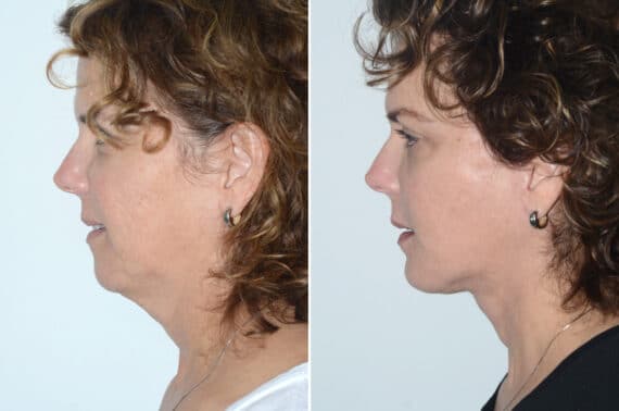 Deep Plane Facelift Before and After Photos in Miami, FL, Patient 22862