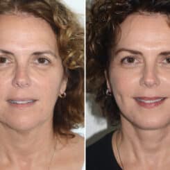 Brow Lift Before and After Photos in Miami, FL, Patient 22862