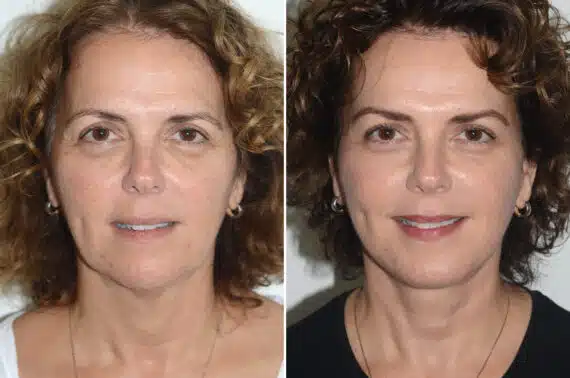 Brow Lift Before and After Photos in Miami, FL, Patient 22862