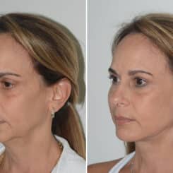 Chin Augmentation Before and After Photos in Miami, FL, Patient 22976