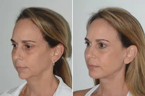 Deep Plane Facelift Before and After Photos in Miami, FL, Patient 22976