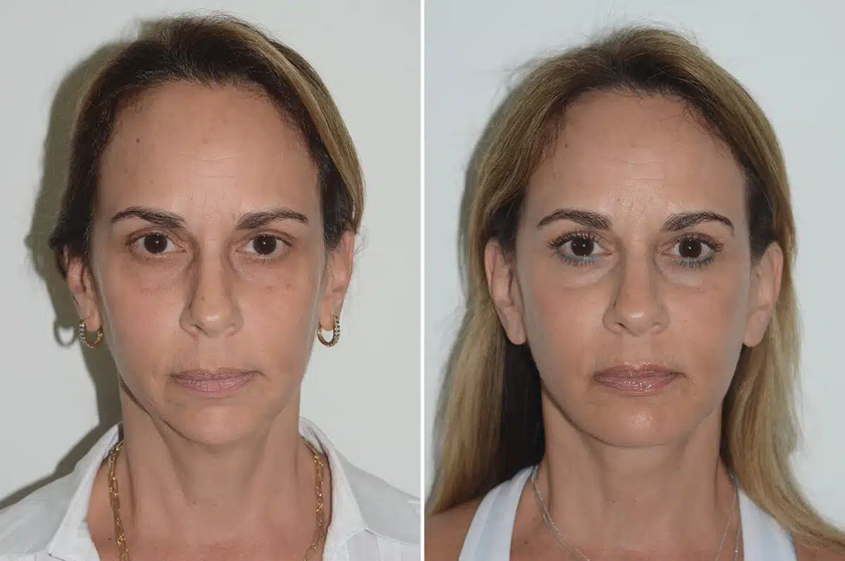 Chin Augmentation Before and After Photos in Miami, FL, Patient 22976