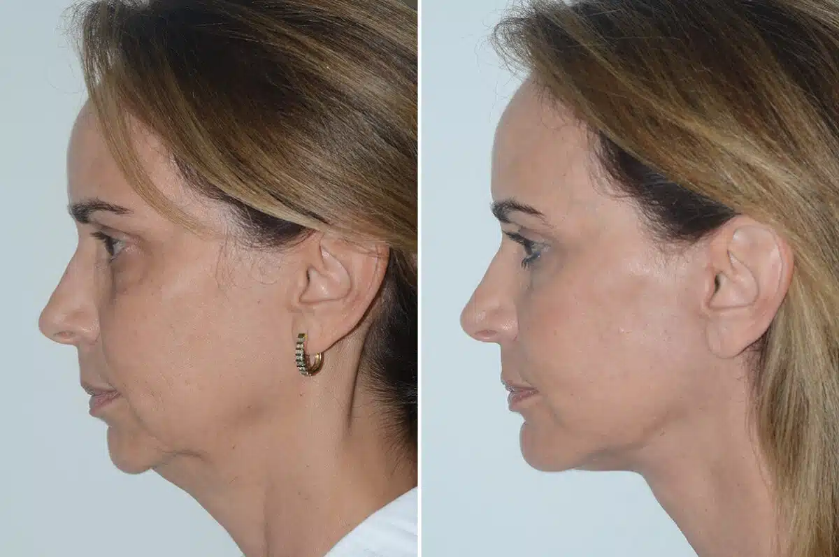 Chin Augmentation Before and After Photos in Miami, FL, Patient 22976