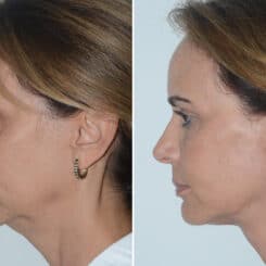 Chin Augmentation Before and After Photos in Miami, FL, Patient 22976