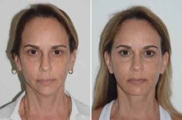 Deep Plane Facelift Before and After Photos in Miami, FL, Patient 22976