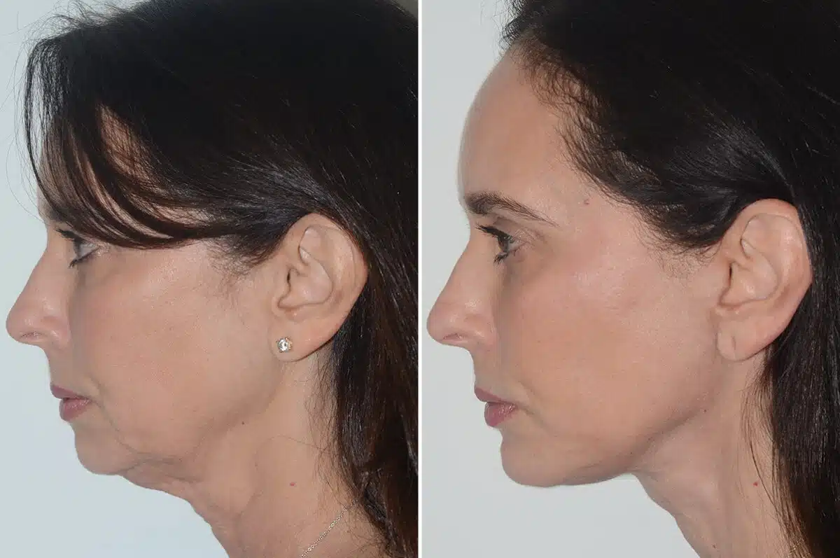 Chin Augmentation Before and After Photos in Miami, FL, Patient 22986