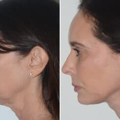 Chin Augmentation Before and After Photos in Miami, FL, Patient 22986