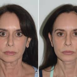 Chin Augmentation Before and After Photos in Miami, FL, Patient 22986