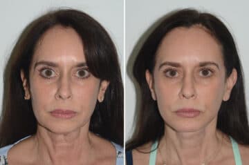 Chin Augmentation Before and After Photos in Miami, FL, Patient 22986