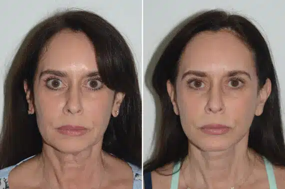 Deep Plane Facelift Before and After Photos in Miami, FL, Patient 22986