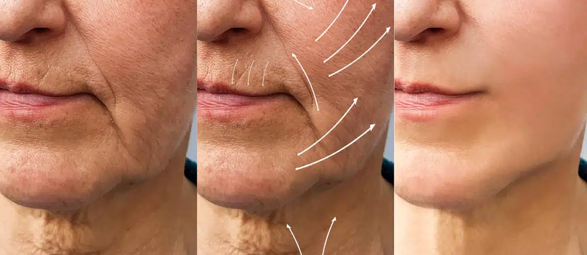 Average facelift and deep plane facelift cost in Florida