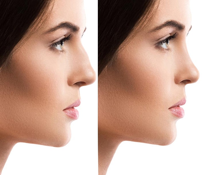 What is the cost of rhinoplasty in Miami?