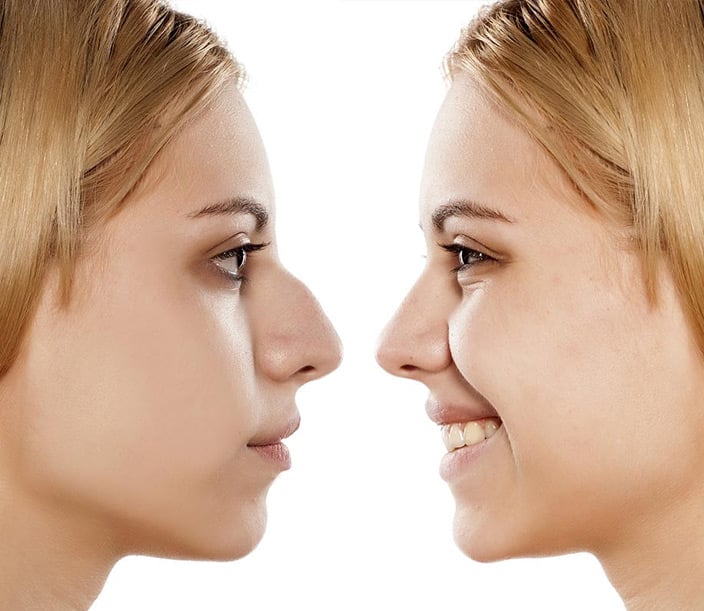 What is the cost of rhinoplasty in South Florida?