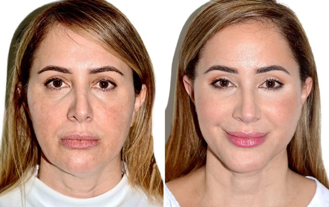 Most patients want a more youthful appearance.