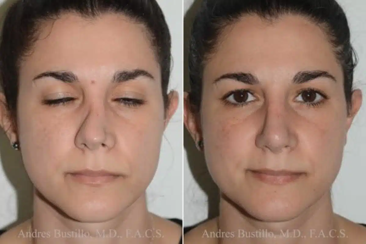 There are many different types of rhinoplasties, including open surgery, closed surgery, endoscopic surgery, and minimally invasive procedures, which impact the cost of rhinoplasty