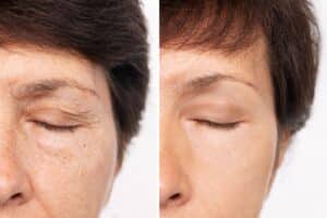 Proper incision care is crucial during this period to prevent infection and promote optimal healing.