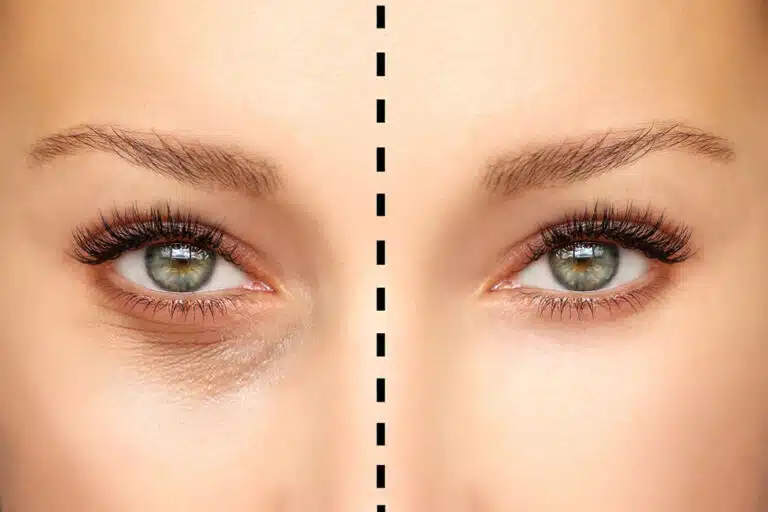 Understanding the Types of Eyelid Surgery