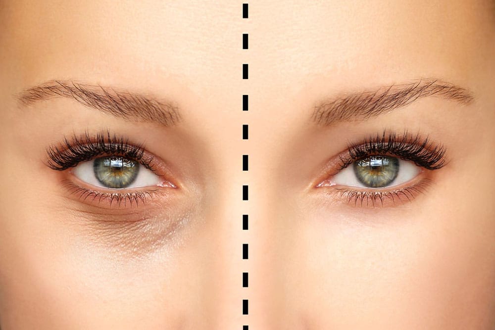 Eyelid surgery can be used to tighten droopy eyelids, giving you a more youthful and alert appearance