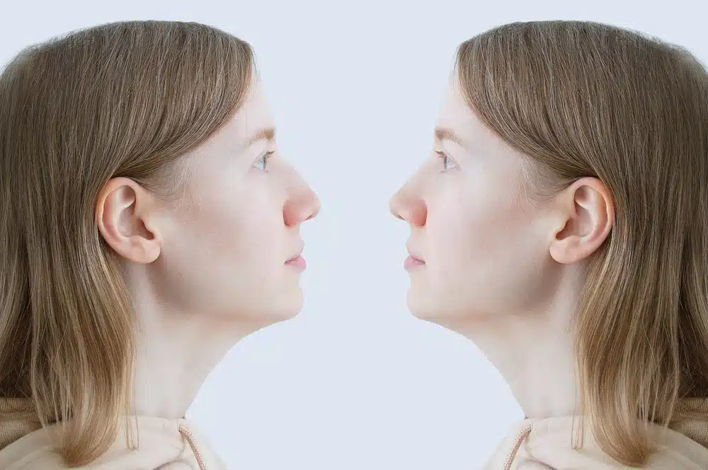 Comparative view of a woman's profile before and after hook nose rhinoplasty, highlighting possible changes.