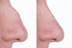 A hook nose job involves reshaping the nasal bridge to reduce the prominent curve or bend, creating a more balanced and proportionate profile.