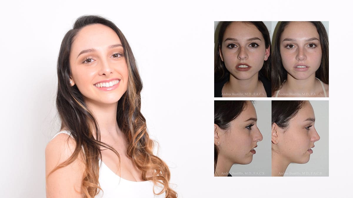 Rhinoplasty in Miami - Figure 3