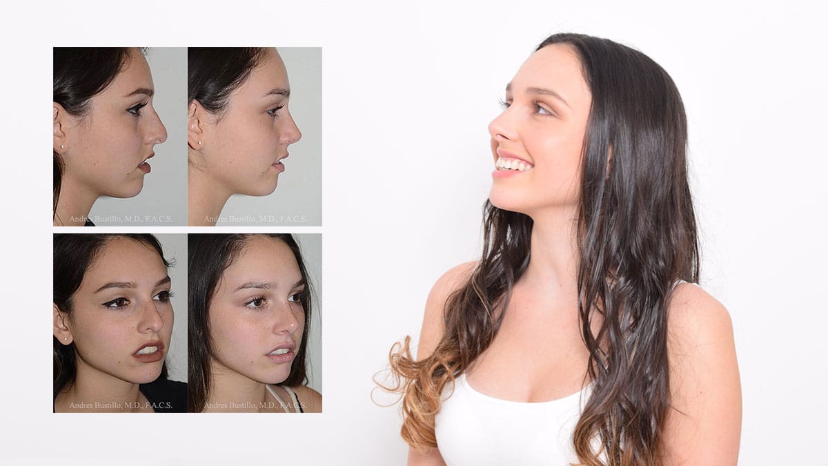 Rhinoplasty in Miami - Figure 4