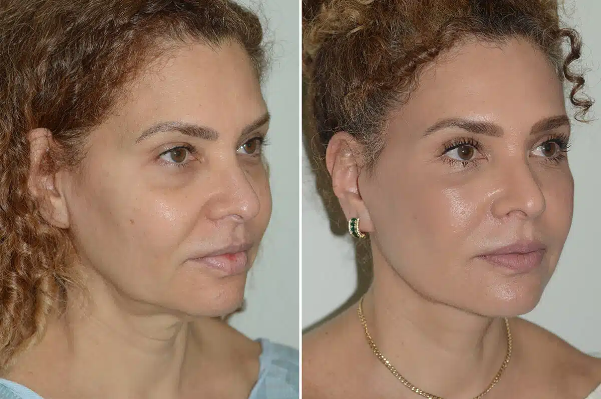 Deep Plane Facelift Before and After Photos in Miami, FL, Patient 25701