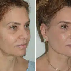 Deep Plane Facelift Before and After Photos in Miami, FL, Patient 25701