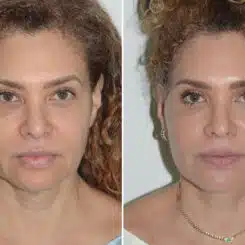 Deep Plane Facelift Before and After Photos in Miami, FL, Patient 25701