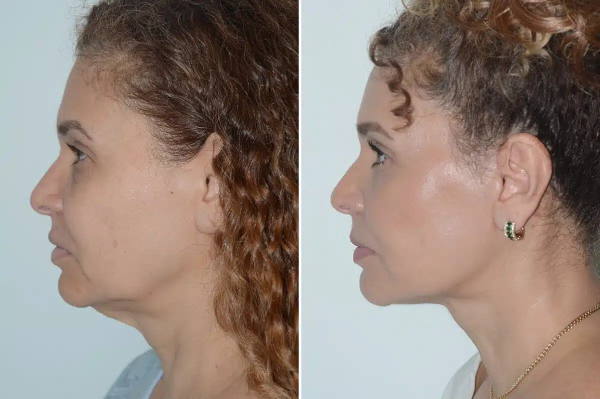 Deep Plane Facelift Before and After Photos in Miami, FL, Patient 25701