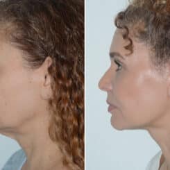 Deep Plane Facelift Before and After Photos in Miami, FL, Patient 25701