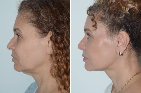 Deep Plane Facelift Before and After Photos in Miami, FL, Patient 25701
