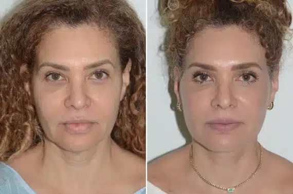 Deep Plane Facelift Before and After Photos in Miami, FL, Patient 25701