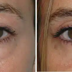 Blepharoplasty (eyelids) Before and After Photos in Miami, FL, Patient 15791