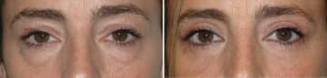 Blepharoplasty (eyelids) Before and After Photos in Miami, FL, Patient 15791