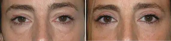 Blepharoplasty (eyelids) Before and After Photos in Miami, FL, Patient 15791