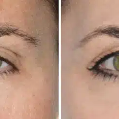 Blepharoplasty (eyelids) Before and After Photos in Miami, FL, Patient 19960