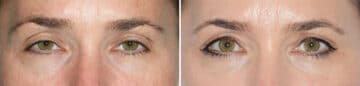 Blepharoplasty (eyelids) Before and After Photos in Miami, FL, Patient 19960