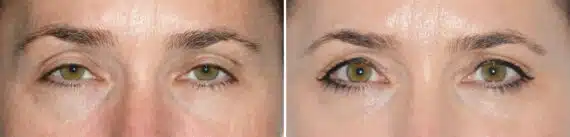 Blepharoplasty (eyelids) Before and After Photos in Miami, FL, Patient 19960