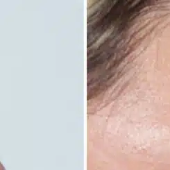 Blepharoplasty (eyelids) Before and After Photos in Miami, FL, Patient 19960