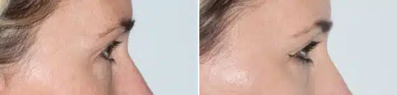Blepharoplasty (eyelids) Before and After Photos in Miami, FL, Patient 19960