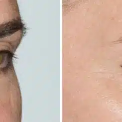 Blepharoplasty (eyelids) Before and After Photos in Miami, FL, Patient 19960