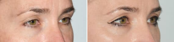 Blepharoplasty (eyelids) Before and After Photos in Miami, FL, Patient 19960