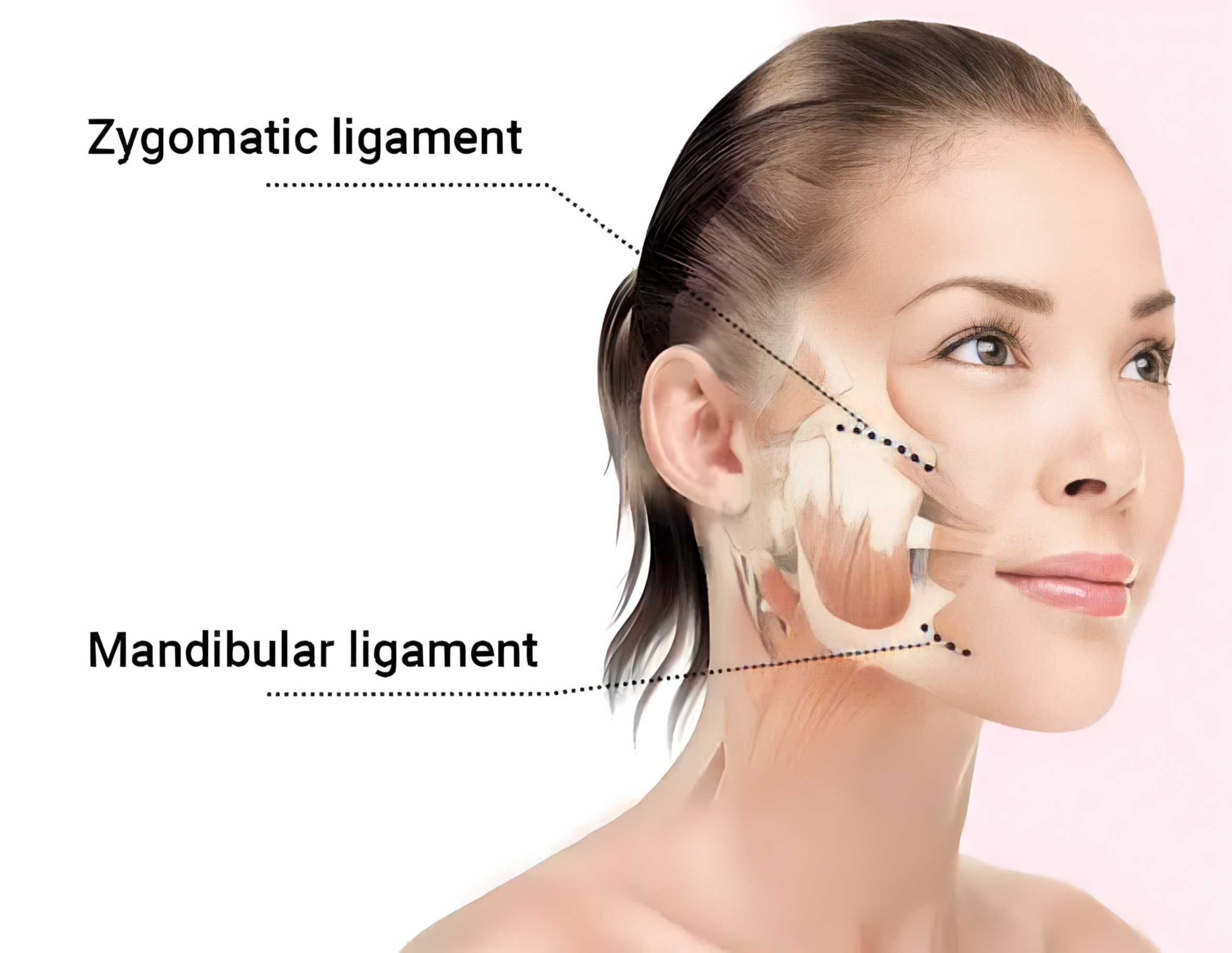 Diagram demonstrating the repositioning and elevation of the muscles of the face during the facelift as performed by Dr. Bustillo.