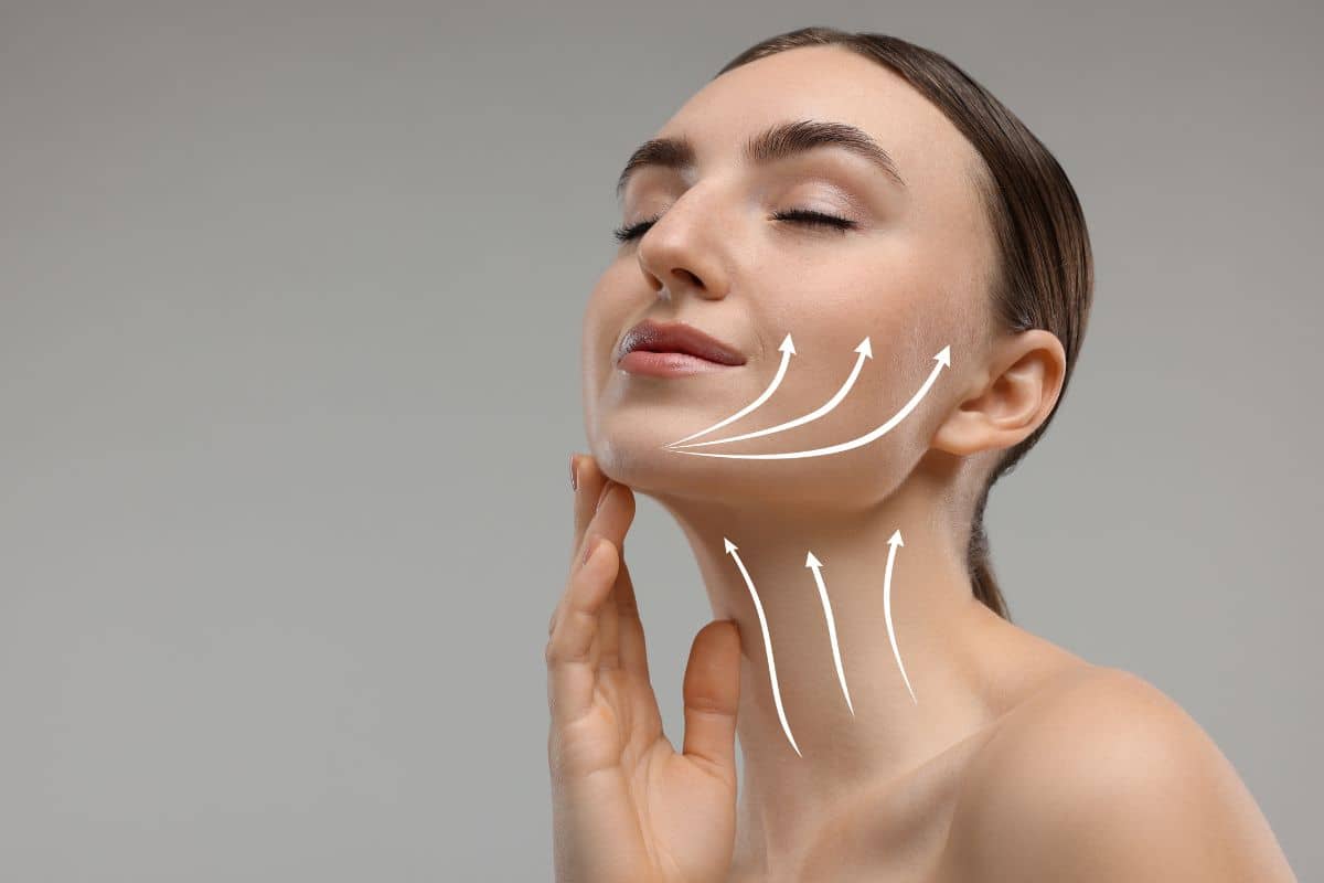 Woman with arrows on face and neck demonstrating lifting vectors of deep plane and SMAS facelift techniques.