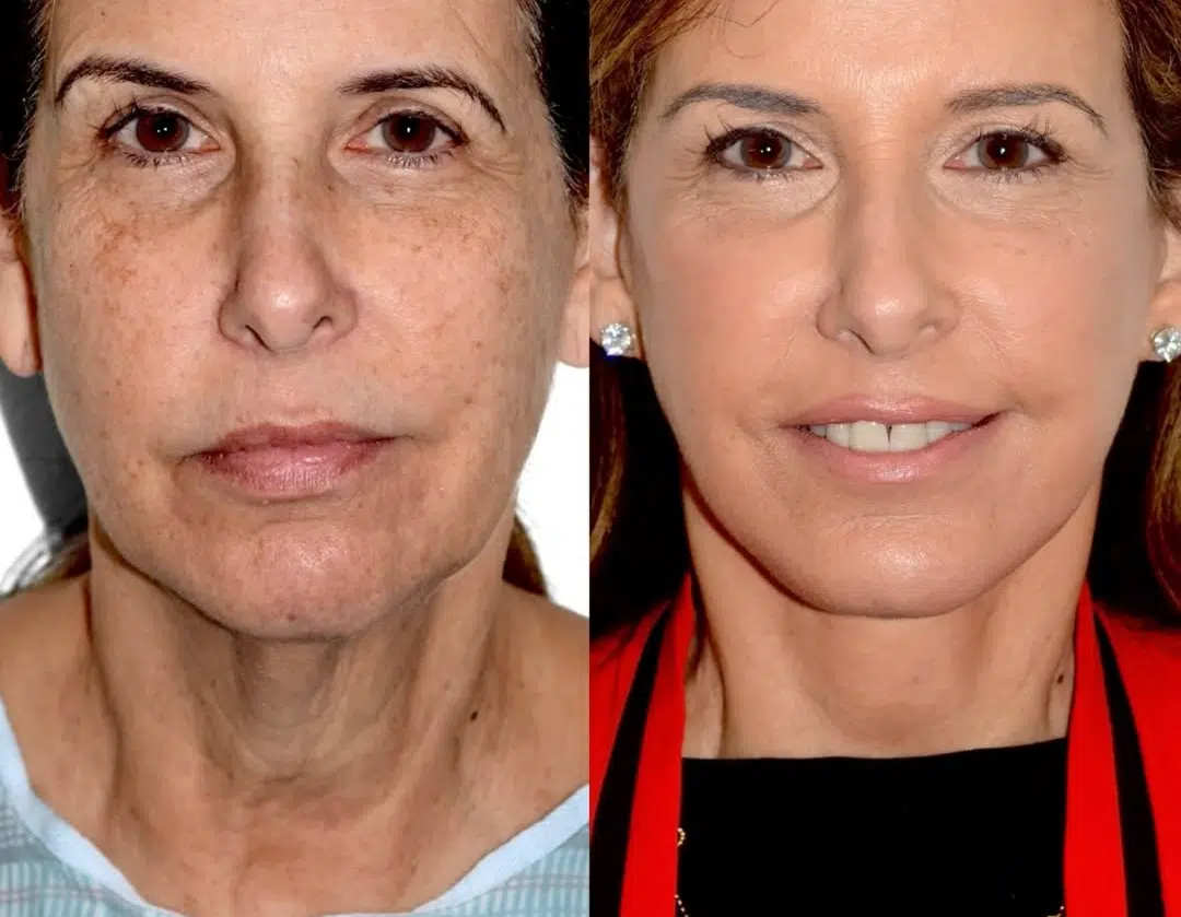 deep-plane-facelift-1-year-1