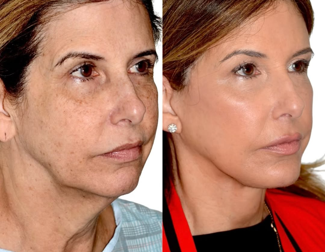 deep-plane-facelift-1-year-2